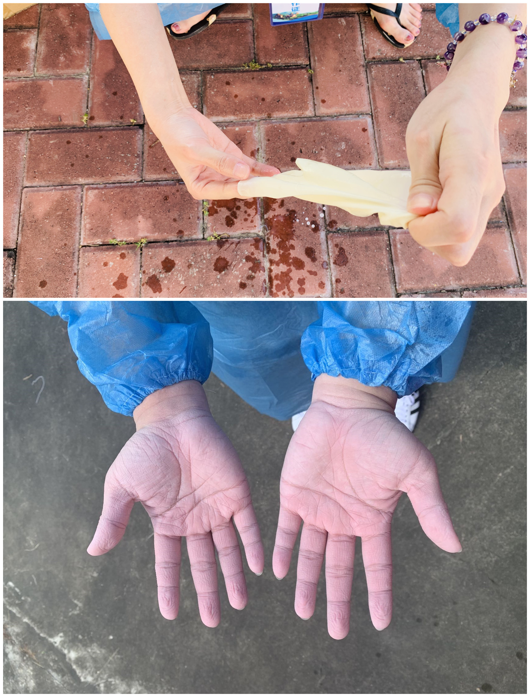 防疫一線工作人員的雙手：脫掉手套，在汗水和消毒液浸泡下發(fā)皺變白.jpg
